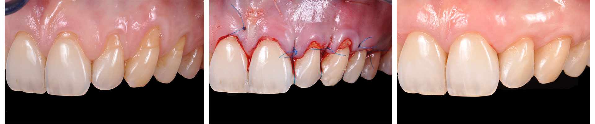 SUTURES